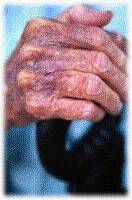 Rheumatoid Arthritis